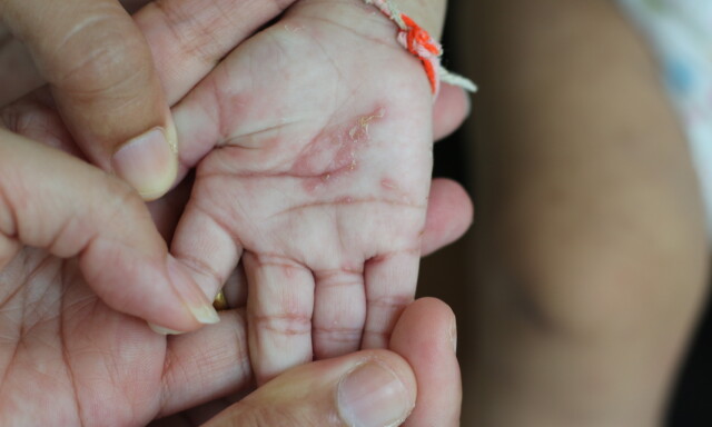 SKABB HOS BABY: Typiske ganger i håndflaten hos baby med skabb. Det kan av og til være små blemmer i utslettet. Dette klør intenst. FOTO: NTB Scanpix / Shutterstock / DonyaHHI SKABB HOS BABY: Typiske ganger i håndflaten hos baby med skabb. Det kan av og til være små blemmer i utslettet. Dette klør intenst. FOTO: NTB Scanpix / Shutterstock / DonyaHHI